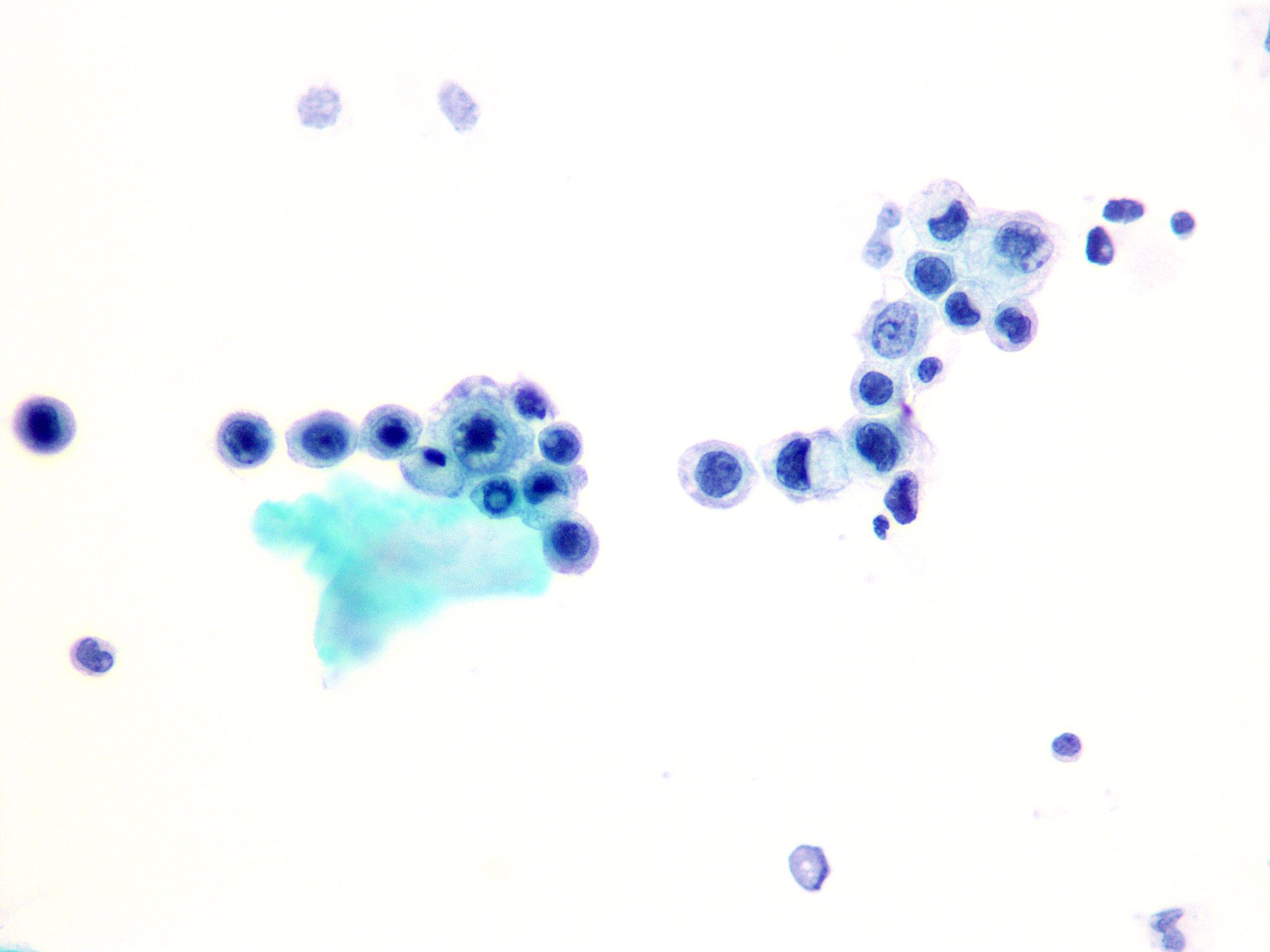 CSF Cytology Saudi Society of Cytotechnology and Histotechnology